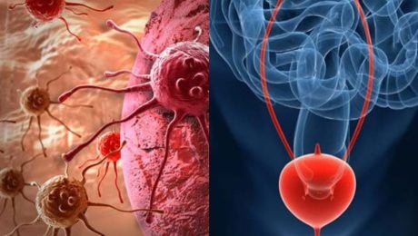 Rakovinu močového mechúra odstránili pomocou nanorobotov